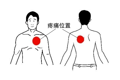 心肌缺血疼痛位置图
