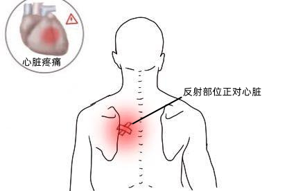心脏病反射后背疼位置图