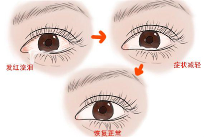 真菌感染眼睛恢复过程图